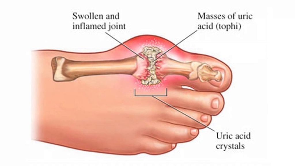The Painful Condition of Gout Maplewood Sauk Prairie